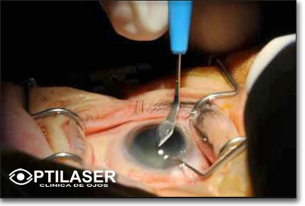 Clinica de ojos Optilaser - Cirugia Cataratas